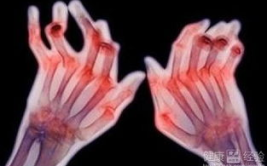 类风湿吃什么药效果好,类风湿关节炎药物治疗指南